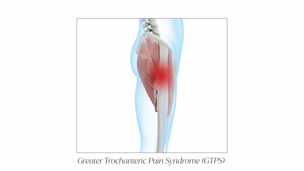 Greater Trochanteric Pain Syndrome